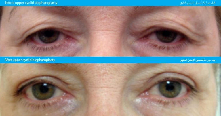 Before-and-after comparison of a person’s eyes showing the results of upper eyelid blepharoplasty surgery, with the top image displaying drooping eyelids and puffiness, and the bottom image showing lifted, smoother eyelids and a more open appearance.