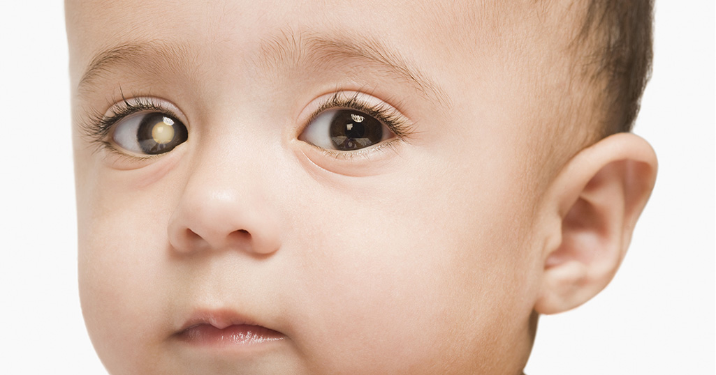 Image of a child with cornea issue indicating Pediatric retinoblastoma case highlighting signs of a malignant eye tumor