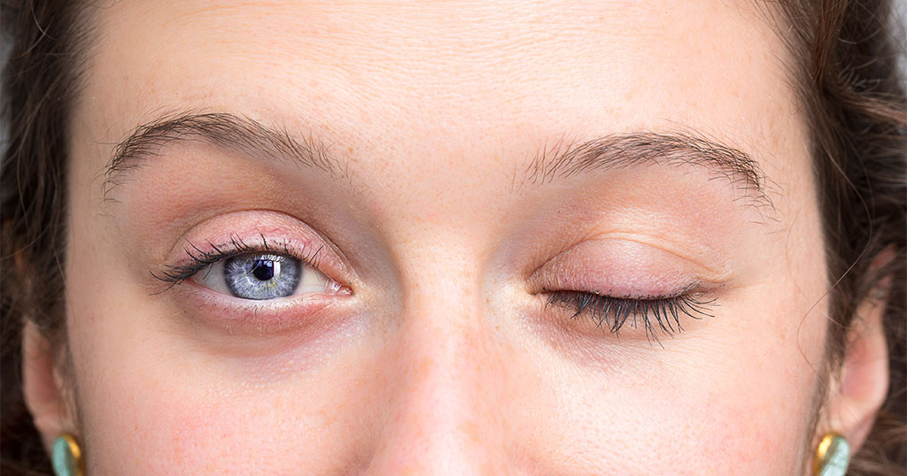 Close-up of facial asymmetry suggestive of facial nerve palsy, highlighting eyelid closure difficulty