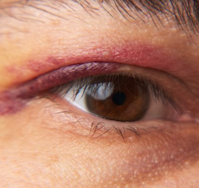 Close-up of an eye with a red, swollen upper eyelid showing signs of infection or inflammation.