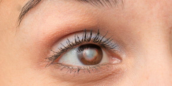 Close-up of an eye showing signs of a corneal opacity, commonly assessed in ophthalmology clinics for vision changes.