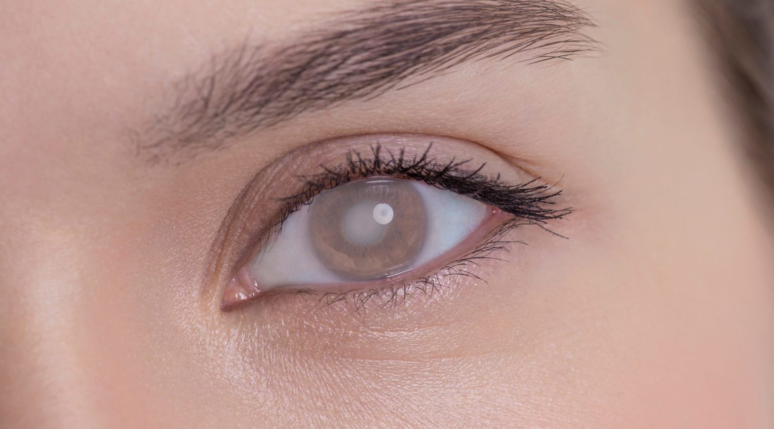 Close up of an eye with clouded lens showing cataract in adults