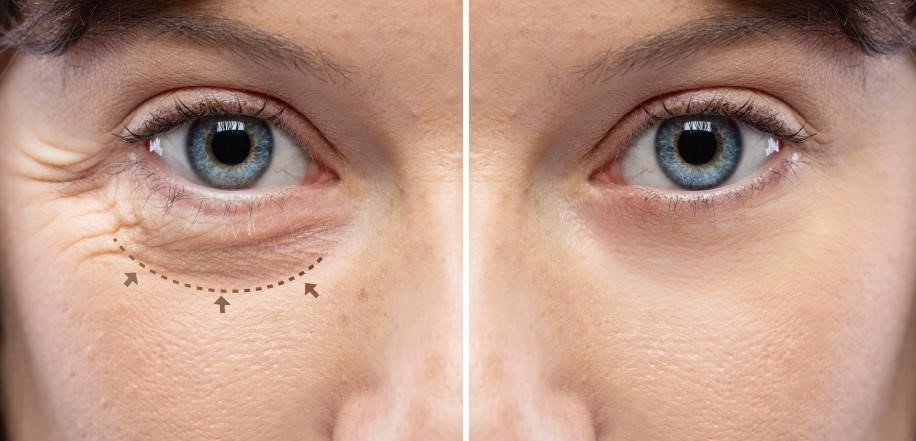 Close-up comparison of a person’s eye area showing before and after blepharoplasty treatment results; the left side displays under-eye wrinkles and puffiness marked by dotted arrows, while the right side shows smoother, firmer skin with reduced wrinkles.