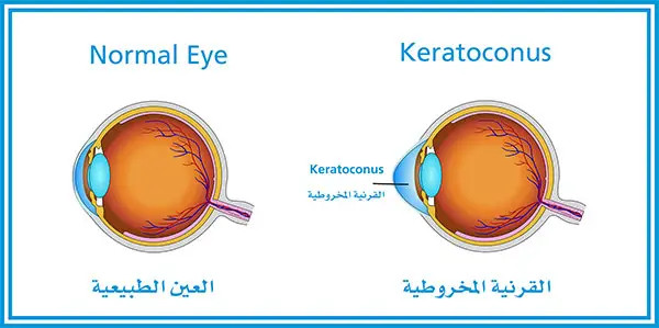 Medical illustration comparing a normal eye with an eye affected by keratoconus, showing the cornea bulging into a cone shape; labels appear in English and Arabic.
