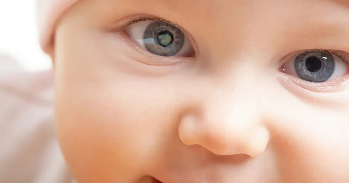Close up of an infant with visible congenital cataract in the left eye
