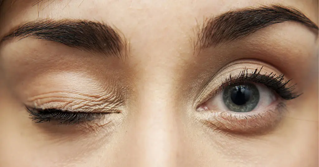 Close-up of a person’s face showing one eye open and the other eyelid drooping, demonstrating ptosis (drooping eyelid).