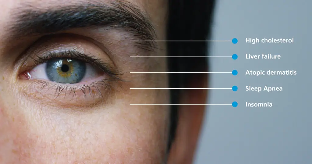 Image of an eye showing with a list of general health conditions related to eyes such as high cholestrol, liver issues, sleep apnea and insomnia