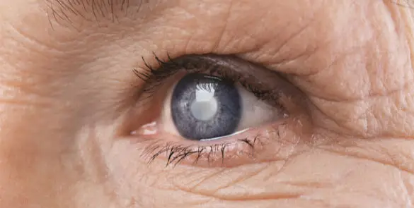 Close-up image of an older person’s eye showing a cloudy, bluish-grey appearance of the pupil, commonly associated with advanced glaucoma.