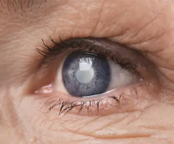 Close-up of an eye showing a cloudy, opaque lens, commonly associated with cataracts rather than glaucoma. The surrounding skin has visible wrinkles.