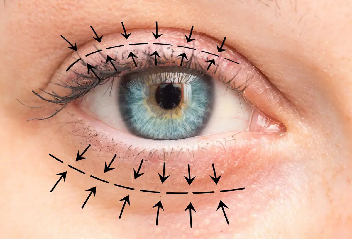 Diagram of eyelid surgery planning, showing markings for cosmetic correction or  blepharoplasty surgery at Moorfields Eye Hospital dubai