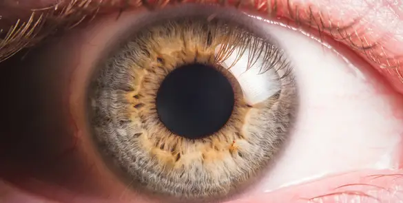 Eye affected by corneal disease, showing signs consistent with keratitis or a corneal ulcer
