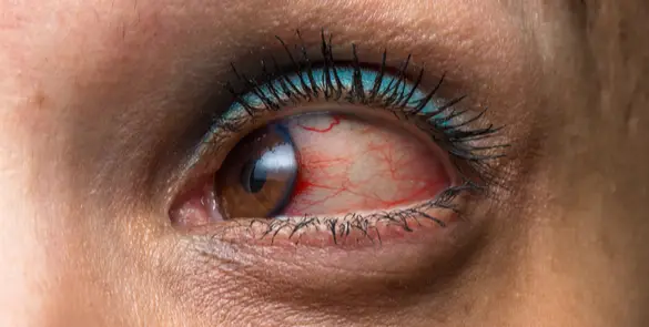 Close up image of an eye that is red and inflammed due to Uveitis