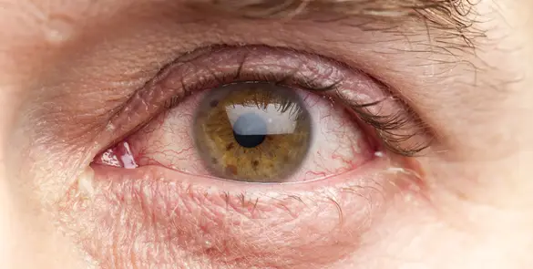 Close-up of an irritated or bloodshot eye, commonly seen with dry eye syndrome, allergies, or eye strain.