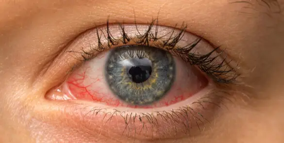 Irritated eye with visible redness and inflamed blood vessels on the sclera