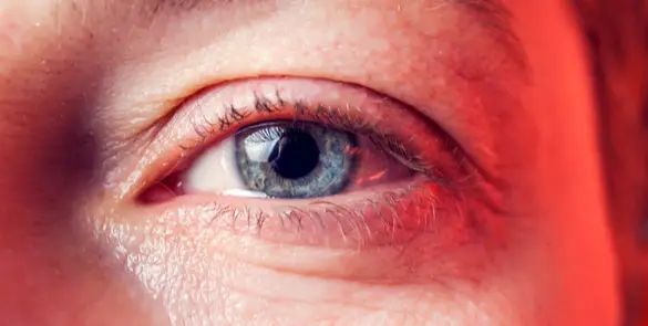 Close-up of the eye with tears  often due duct inflammation, often associated with blocked tear drainage or dacryocystitis.