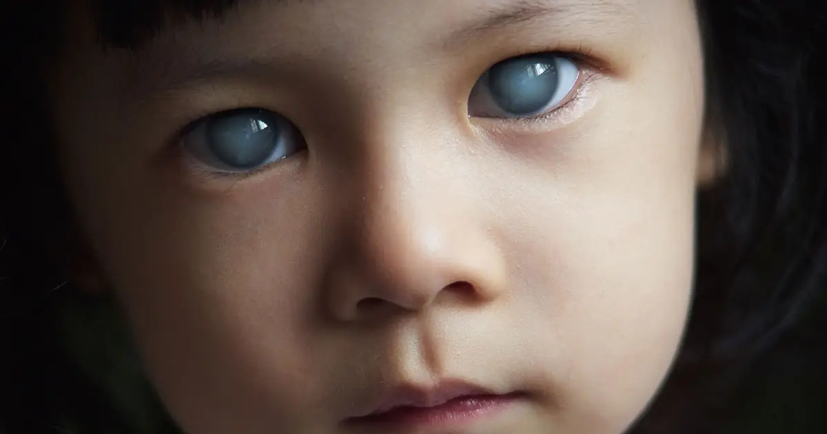 Close-up of a young child with cloudy blue-grey corneas in both eyes, suggesting advanced bilateral cataracts or a similar ocular condition.