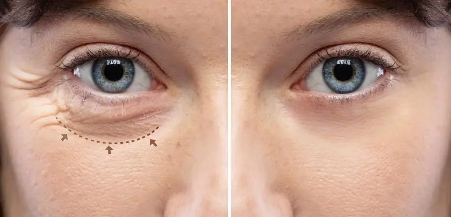 Close-up comparison of a person’s eye area showing before and after blepharoplasty treatment results; the left side displays under-eye wrinkles and puffiness marked by dotted arrows, while the right side shows smoother, firmer skin with reduced wrinkles.